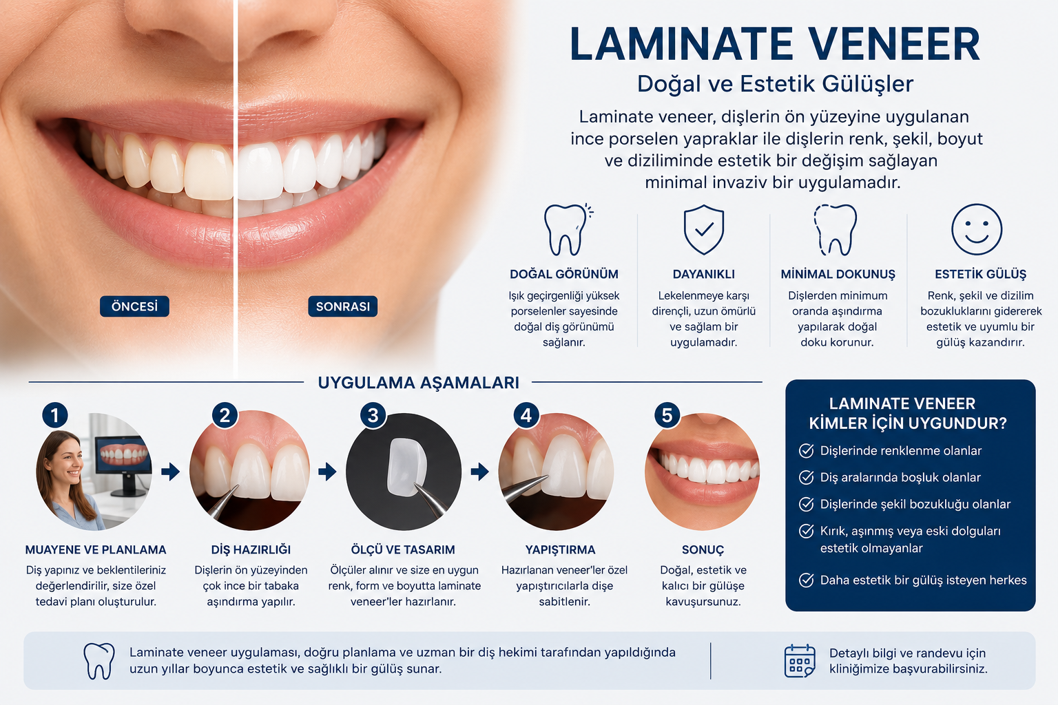 Laminate Veneer Uygulaması
